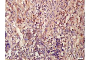 Formalin-fixed and paraffin embedded human lung carcinoma labeled with Anti-Tubulin-Beta Polyclonal Antibody, Unconjugated (ABIN672231) at 1:200 followed by conjugation to the secondary antibody and DAB staining (TUBB3 antibody  (AA 31-130))