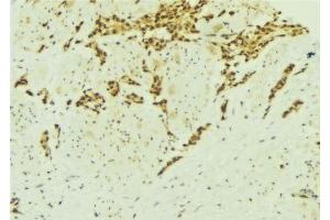 ABIN6277137 at 1/100 staining Human breast cancer tissue by IHC-P. (ATF2 antibody  (N-Term))
