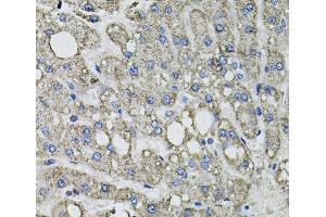Immunohistochemistry of paraffin-embedded Human liver damage using GFPT1 Polyclonal Antibody at dilution of 1:100 (40x lens). (GFPT1 antibody)