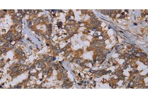 Immunohistochemistry of paraffin-embedded Human liver cancer using REG3G Polyclonal Antibody at dilution of 1:40 (REG3g antibody)