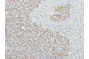 IHC-P Image Immunohistochemical analysis of paraffin-embedded human breast cancer, using NARS, antibody at 1:250 dilution. (NARS antibody)