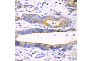 Immunohistochemistry of paraffin-embedded human gastric cancer using CHIA antibody (ABIN5971776) at dilution of 1/100 (40x lens). (CHIA antibody)