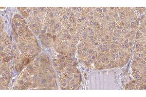 ABIN6277481 at 1/100 staining Human Melanoma tissue by IHC-P. (Neurotrophin 4 antibody  (Internal Region))