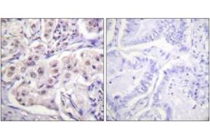 Immunohistochemistry analysis of paraffin-embedded human lung carcinoma tissue, using hnRPD (Ab-83) Antibody. (HNRNPD/AUF1 antibody  (AA 49-98))