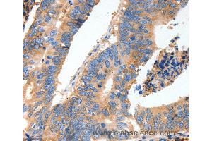 Immunohistochemistry of Human thyroid cancer using MUC6 Polyclonal Antibody at dilution of 1:40 (MUC6 antibody)