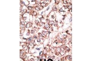Formalin-fixed and paraffin-embedded human cancer tissue reacted with the primary antibody, which was peroxidase-conjugated to the secondary antibody, followed by DAB staining. (DKK2 antibody  (N-Term))