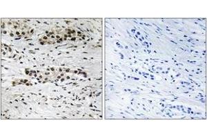 Immunohistochemistry analysis of paraffin-embedded human breast carcinoma, using Estrogen Receptor-alpha (Phospho-Ser102) Antibody.