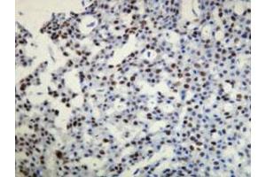 Immunohistochemical staining (Formalin-fixed paraffin-embedded sections) of human breast cancer with PGR monoclonal antibody, clone A21-W . (Progesterone Receptor antibody  (N-Term))