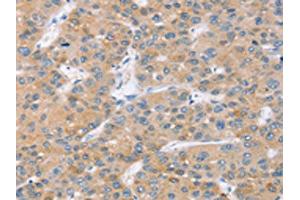 The image on the left is immunohistochemistry of paraffin-embedded Human liver cancer tissue using ABIN7131090(SLC27A2 Antibody) at dilution 1/20, on the right is treated with fusion protein. (SLC27A2 antibody)