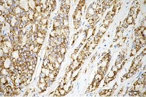 Immunohistochemistry was performed on paraffin-embedded human prostatic adenocarcinoma using arg2 antibody (ABIN7797644), 1:200). (Recombinant ARG2 antibody)