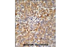 Formalin-fixed and paraffin-embedded human prostate carcinoma reacted with ALKBH3 Antibody (C-term), which was peroxidase-conjugated to the secondary antibody, followed by DAB staining. (ALKBH3 antibody  (C-Term))