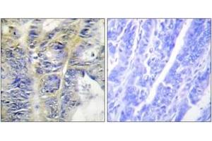 Immunohistochemistry analysis of paraffin-embedded human colon carcinoma tissue, using Collagen IV alpha5 Antibody. (COL4a5 antibody  (AA 21-70))