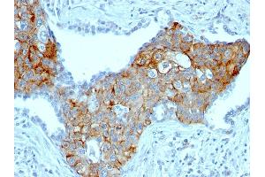 Formalin-fixed, paraffin-embedded human Lung SqCC stained with TRIM29 Mouse Monoclonal Antibody (TRIM29/1041). (TRIM29 antibody  (AA 1-200))