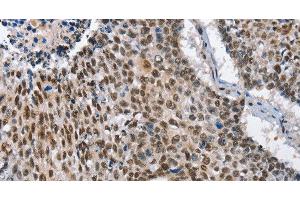 Immunohistochemistry of paraffin-embedded Human lung cancer tissue using GNRH1 Polyclonal Antibody at dilution 1:65 (GNRH1 antibody)
