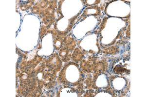 Immunohistochemistry of Human thyroid cancer using LAMA4 Polyclonal Antibody at dilution of 1:30