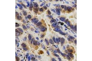 Immunohistochemical analysis of Caspase 9 p35 staining in human lung cancer formalin fixed paraffin embedded tissue section. (Caspase 9 p35 antibody)