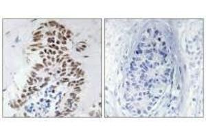 Immunohistochemistry analysis of paraffin-embedded human lung carcinoma tissue using DAPK3 (Ab-265) antibody. (DAPK3 antibody  (Thr265))