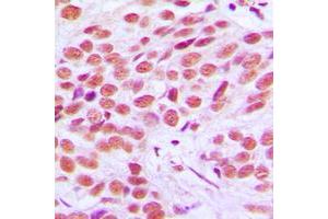 Immunohistochemical analysis of FRA2 staining in human breast cancer formalin fixed paraffin embedded tissue section. (FOSL2 antibody  (C-Term))