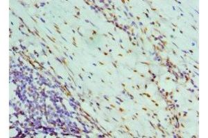 Immunohistochemistry of paraffin-embedded human colon cancer using ABIN7161690 at dilution of 1:100 (NONO antibody  (AA 1-300))