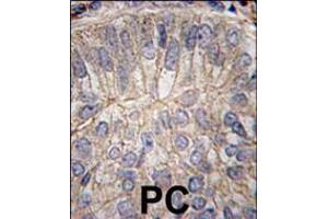 Formalin-fixed and paraffin-embedded human prostate carcinoma tissue reacted with CDH3 antibody , which was peroxidase-conjugated to the secondary antibody, followed by DAB staining. (P-Cadherin antibody  (C-Term))