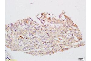 Formalin-fixed and paraffin embedded human cervical carcinoma tissue labeled with Anti-CYP24A1 Polyclonal Antibody, Unconjugated  at 1:200 followed by conjugation to the secondary antibody and DAB staining (CYP24A1 antibody  (AA 351-450))