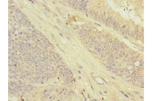Immunohistochemistry of paraffin-embedded human colon cancer using ABIN7154564 at dilution of 1:100 (GRPEL2 antibody  (AA 33-225))