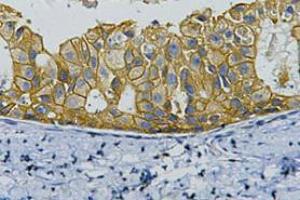 Immunohistochemistry (IHC) staining of Human Breast cancer tissue, diluted at 1:200. (ErbB2/Her2 antibody)