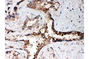 IHC-P: PP2A antibody testing of human lung cancer tissue (PPP2R4 antibody  (AA 1-309))