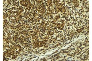 ABIN6277725 at 1/100 staining Human breast cancer tissue by IHC-P. (ATR antibody  (pSer428))