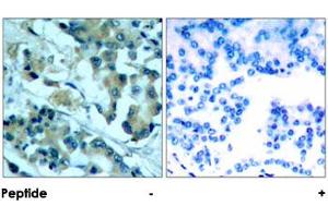 Immunohistochemical analysis of paraffin-embedded human lung carcinoma tissue using MAP2K1 polyclonal antibody . (MEK1 antibody)