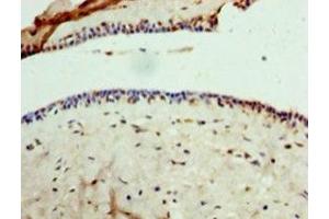 Immunohistochemistry of paraffin-embedded human breast cancer using ABIN7154159 at dilution of 1:100 (GPD1 antibody  (AA 1-349))