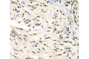 Immunohistochemistry of paraffin-embedded Human gastric cancer using CHEK1 Polyclonal Antibody at dilution of 1:100 (40x lens). (CHEK1 antibody)