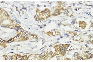 Immunohistochemistry of paraffin-embedded Human liver cancer using HACE1 Polyclonal Antibody at dilution of 1:100 (40x lens). (HACE1 antibody)