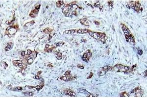 Immunohistochemistry (IHC) analyzes of p-CaMK2-a antibody in paraffin-embedded human breast carcinoma tissue. (CAMK2A antibody  (pThr286))