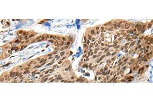 Immunohistochemistry of paraffin-embedded Human esophagus cancer tissue using XPO1 Polyclonal Antibody at dilution of 1:40(x200) (XPO1 antibody)