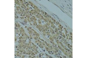Immunohistochemistry of paraffin-embedded human colon carcinoma using RSRC1 antibody (ABIN5974341) at dilution of 1/100 (40x lens). (RSRC1 antibody)