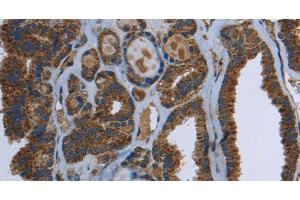 Immunohistochemistry of paraffin-embedded Human thyroid cancer using GCK Polyclonal Antibody at dilution of 1:40 (GCK antibody)