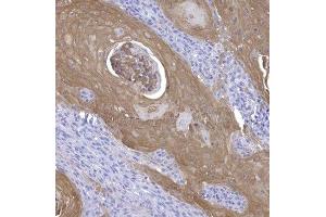 Calprotectin positive tumor cells in squamous cell carcinoma. (Calprotectin antibody)