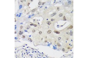Immunohistochemistry of paraffin-embedded Human breast cancer using UCKL1 Rabbit pAb (ABIN7271233) at dilution of 1:100 (40x lens). (UCKL1 antibody  (AA 1-200))