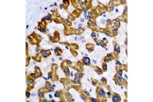 Immunohistochemical analysis of NDUFA2 staining in human liver cancer formalin fixed paraffin embedded tissue section. (NDUFA2 antibody)