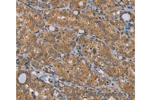 Immunohistochemistry of Human thyroid cancer using TRIM29 Polyclonal Antibody at dilution of 1:50