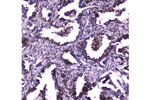 IHC testing of FFPE human lung cancer tissue with TLR1 antibody at 1ug/ml. (TLR1 antibody)
