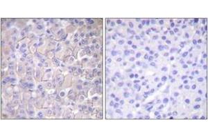 Immunohistochemistry analysis of paraffin-embedded human breast carcinoma, using EGFR (Phospho-Thr693) Antibody.