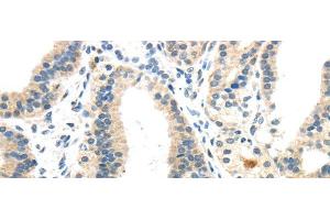 Immunohistochemistry of paraffin-embedded Human thyroid cancer using INHBB Polyclonal Antibody at dilution of 1/40 (INHBB antibody)