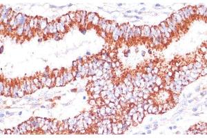 Immunohistochemistry of paraffin-embedded Human colon carcinoma using ENTPD6 Polyclonal Antibody at dilution of 1:100 (40x lens). (ENTPD6 antibody)