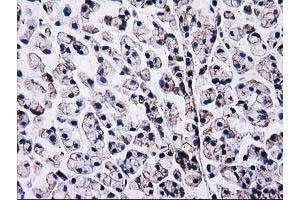 Immunohistochemical staining of paraffin-embedded Adenocarcinoma of Human colon tissue using anti-CTNNB1 mouse monoclonal antibody. (CTNNB1 antibody)