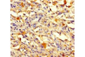 Immunohistochemistry of paraffin-embedded human melanoma using ABIN7171199 at dilution of 1:100 (Sorting Nexin 1 antibody  (AA 1-250))