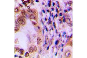 Immunohistochemical analysis of STAT1 staining in human lung cancer formalin fixed paraffin embedded tissue section. (STAT1 antibody  (C-Term))