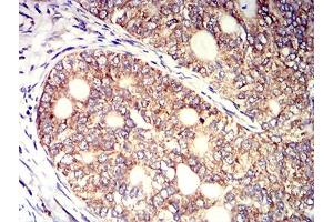 Immunohistochemical analysis of paraffin-embedded cervical cancer tissues using KIR3DL1 mouse mAb with DAB staining. (KIR3DL1 antibody  (AA 22-340))