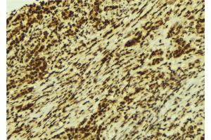 ABIN6274262 at 1/100 staining Human breast cancer tissue by IHC-P. (CSNK1A1 antibody  (Internal Region))